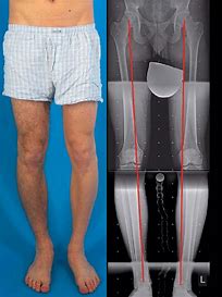 Varus Deformity and OA knee