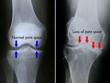 Knee Pain biomechanics